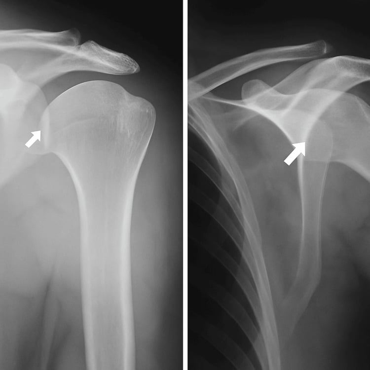 AP radiograph of the left shoulder showing a large wedge-shaped Hill-Sachs lesion of the superolateral humeral head