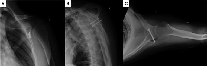 Postoperative Latarjet radiographs in AP oblique, scapular-Y and axillary views showing the transferred coracoid on the anterior glenoid