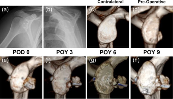 AP and scapular-Y radiographs after failed Bankart repairs, then serial 3D CT en-face views after Latarjet coracoid transfer