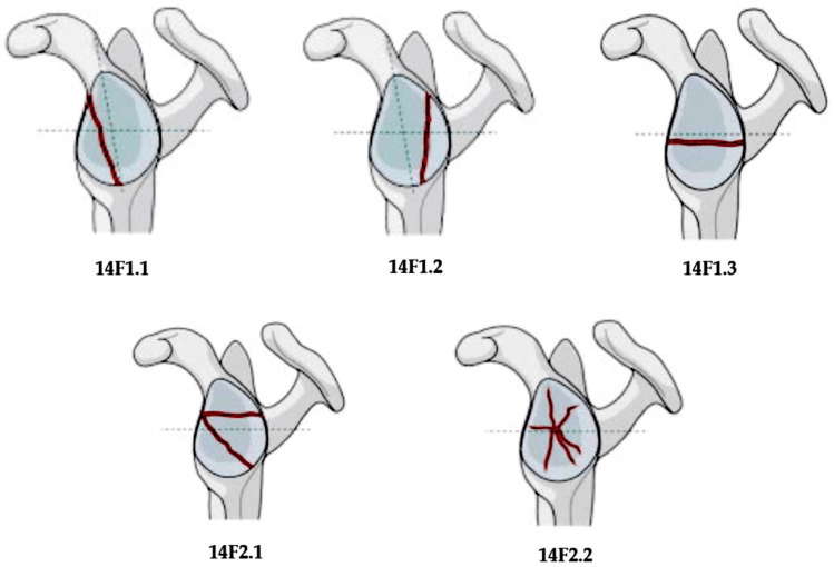 AO/OTA glenoid fossa fracture diagrams coded 14F1.1, 14F1.2, 14F1.3, 14F2.1 and 14F2.2, each drawing marking the fracture lines in red