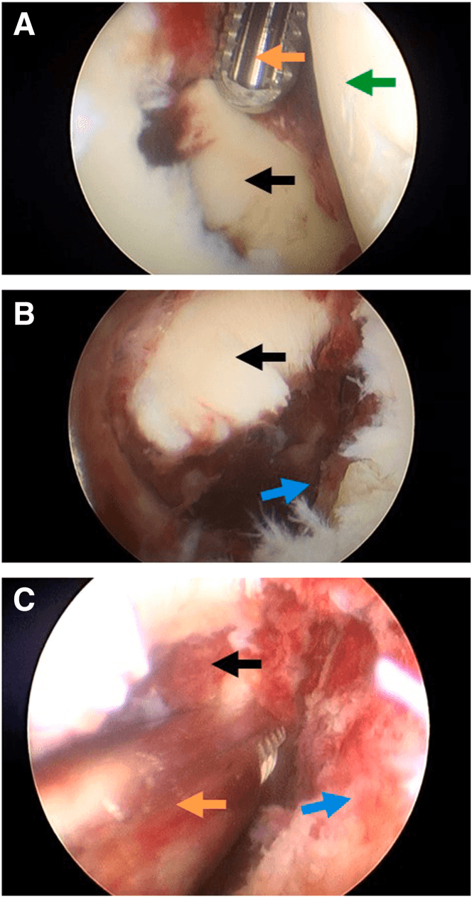 Three arthroscopic views, A to C, of an acute bony Bankart fragment, with coloured arrows marking structures in each view