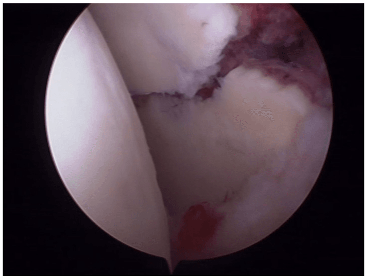 Arthroscopic view of a fracture line crossing the glenoid articular surface