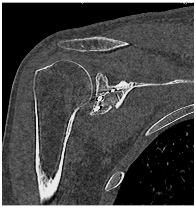 Postoperative CT showing two screws fixing a glenoid fossa fracture