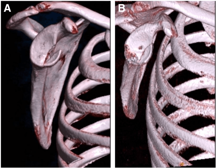 Three-dimensional CT reconstructions with the humerus removed, before (A) and after (B) fixation of an acute bony Bankart fracture