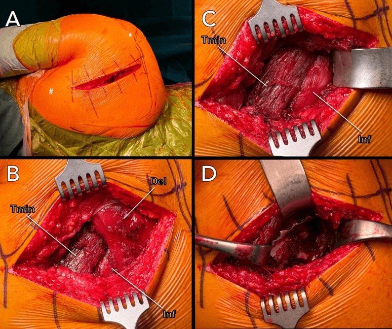 Four operative photographs of the Brodsky posterior scapular approach: the marked incision (A), deltoid, teres minor and infraspinatus (B), teres minor and infraspinatus (C) and the deep exposure (D)
