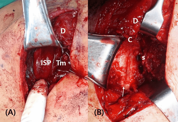 Operative photographs of a posterior deltoid-sparing exposure: in A the deltoid (D) is retracted above infraspinatus (ISP) and teres minor (Tm); B is a deeper view labelled D, C and s, with an arrow