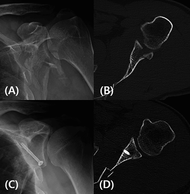 Preoperative radiograph (A) and axial CT (B), and postoperative radiograph (C) and axial CT (D), of a glenoid fracture fixed with a screw