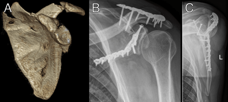 Preoperative three-dimensional CT of the scapula (A) and postoperative radiographs (B, C) showing plate-and-screw fixation