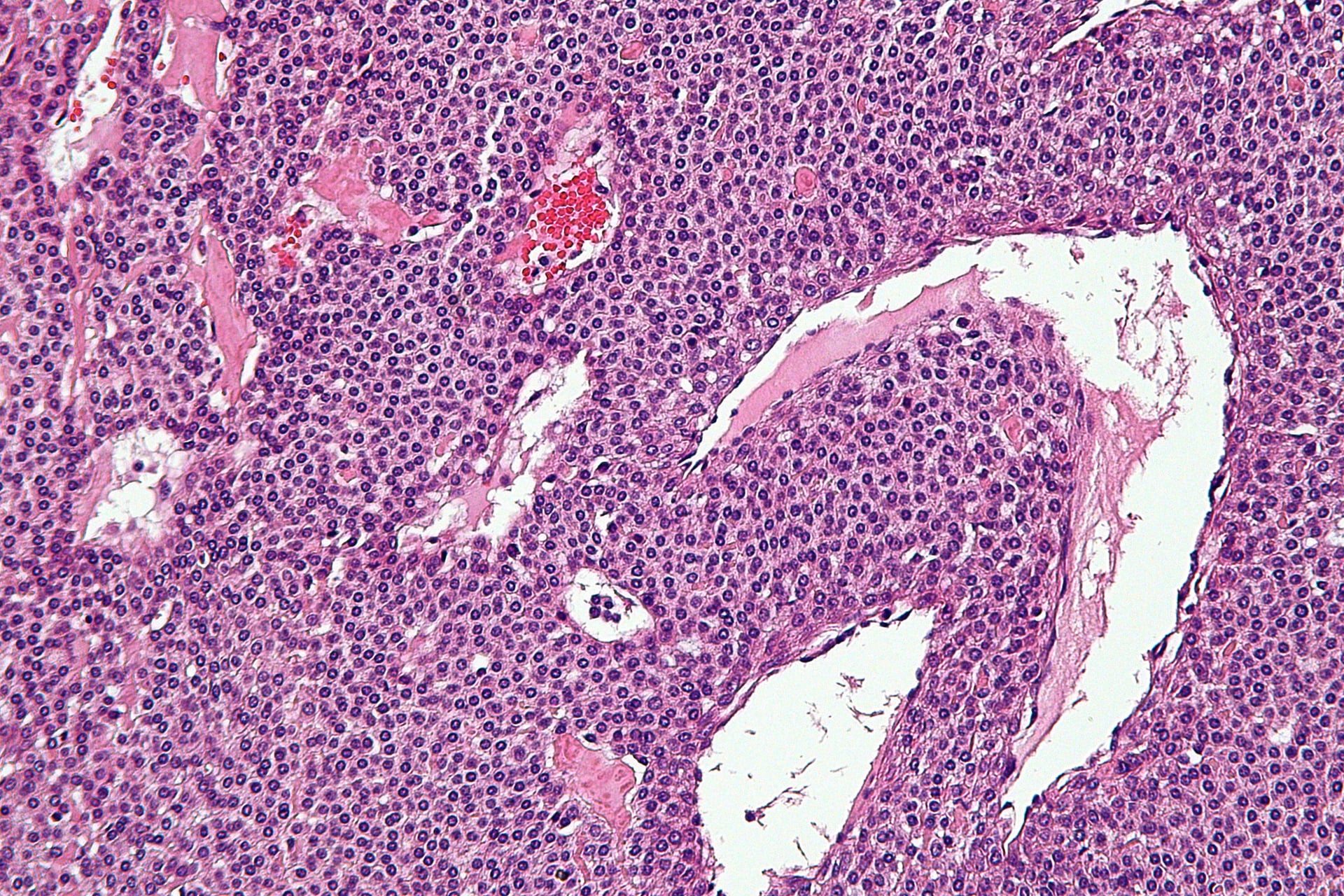 High-magnification H&E micrograph of a glomus tumour showing uniform round glomus cells with centrally placed round nuclei around a vascular channel