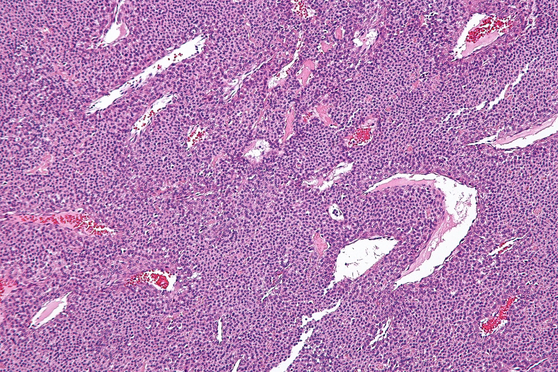 Intermediate-magnification H&E micrograph of a glomus tumour showing sheets of uniform round cells around numerous thin-walled vascular channels
