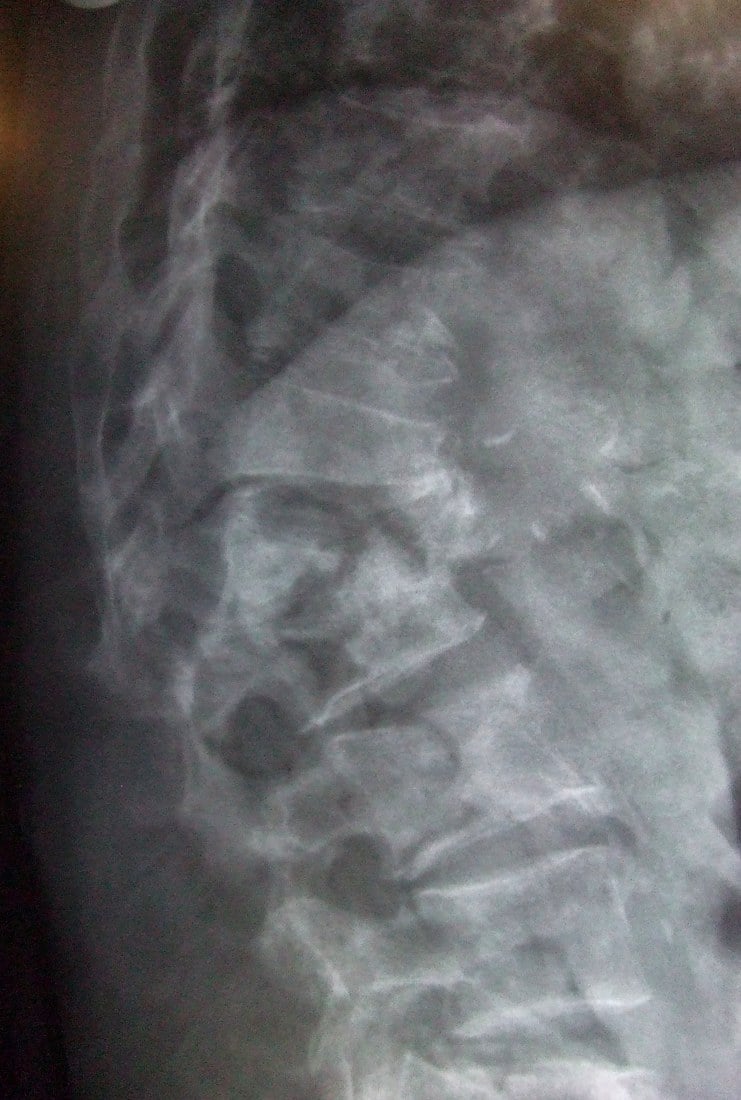 Lateral lumbar spine radiograph showing osteoporotic vertebrae with an anterior wedge compression fracture
