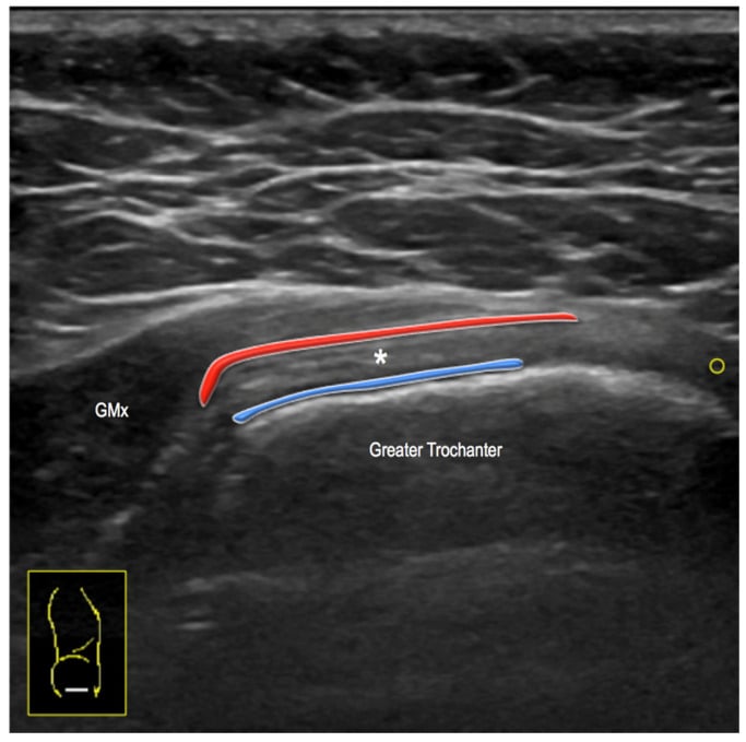 Ultrasound anatomy of gluteus medius and minimus insertions