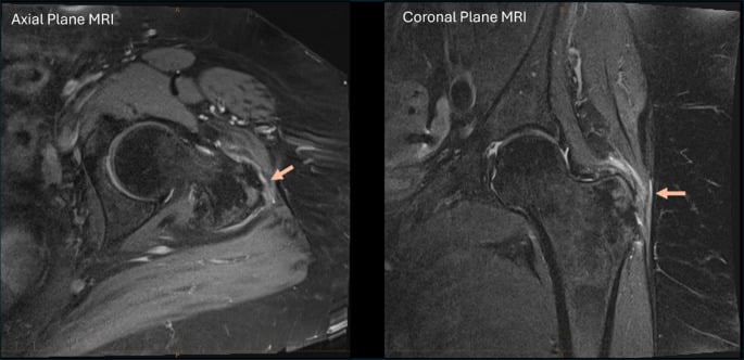 Axial and coronal MRI of gluteus medius and minimus tears