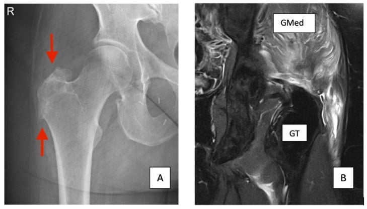 Greater-trochanter spur and torn gluteal tendon on MRI