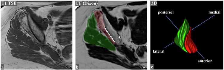 Dixon MRI quantification of gluteal muscle fatty infiltration
