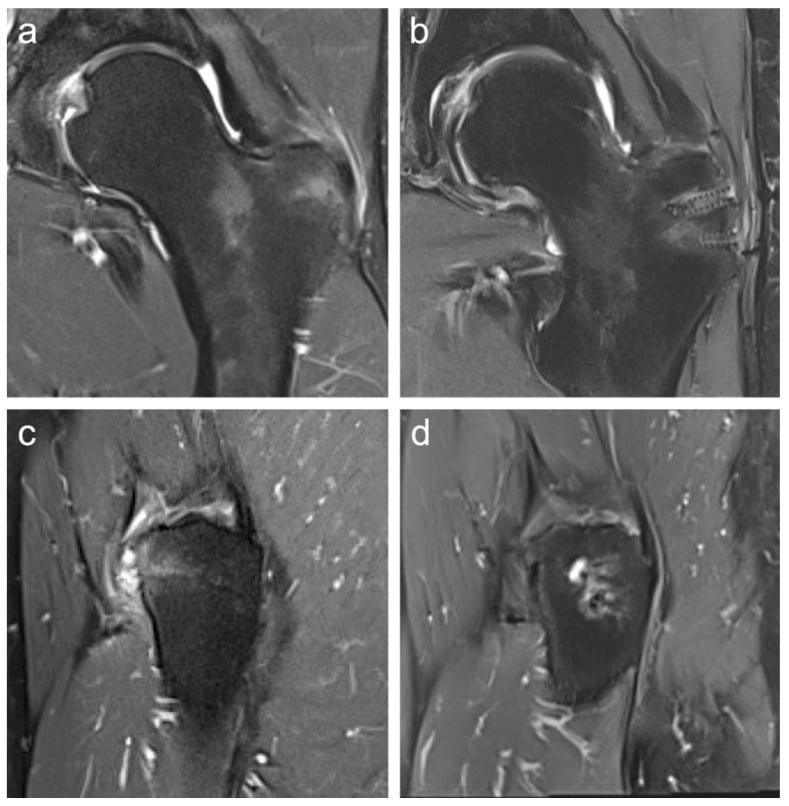 MRI before and after gluteal tendon repair