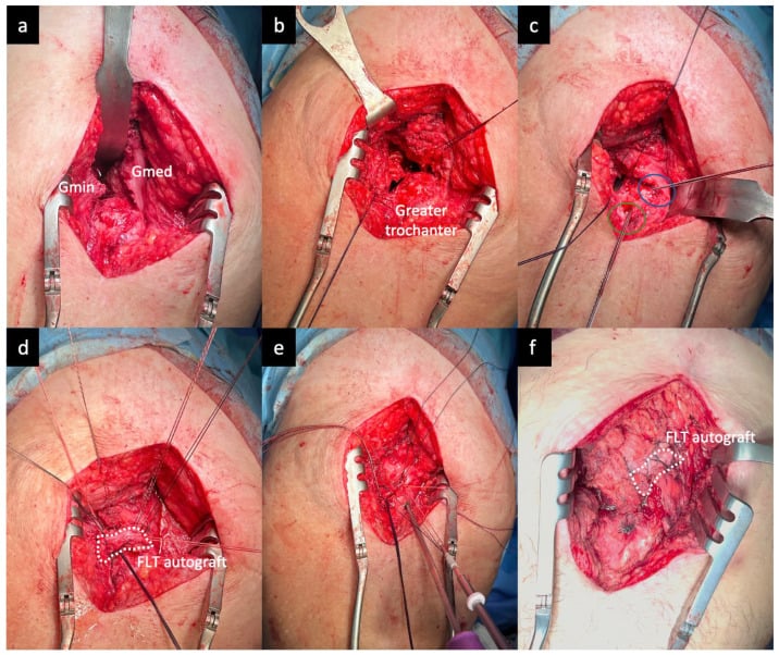 Open double-row hip abductor reconstruction sequence