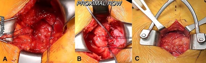 Open gluteus medius and minimus double-row repair