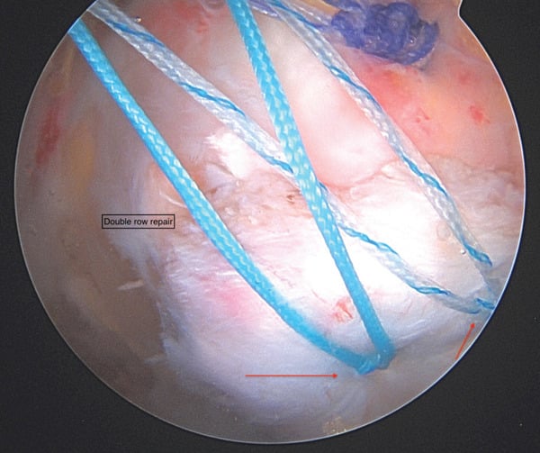 Endoscopic horizontal-mattress sutures through a gluteal tear