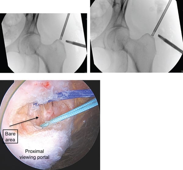 Fluoroscopic and endoscopic gluteal anchor placement