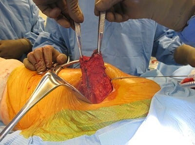 Harvest of a gluteus maximus myofascial flap