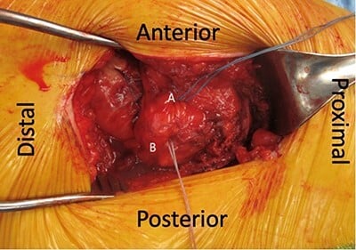 Greater-trochanter anchors for gluteus maximus transfer