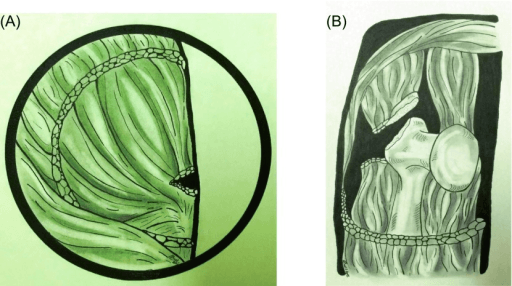 Hand-drawn schematic of abductor mechanism tear patterns with increasing retraction