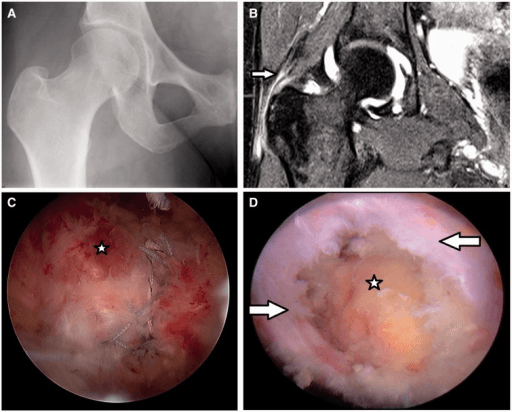 Four-panel figure of a symptomatic gluteus medius tear: AP hip radiograph, coronal fat-suppressed MR image, and two endoscopic peritrochanteric views