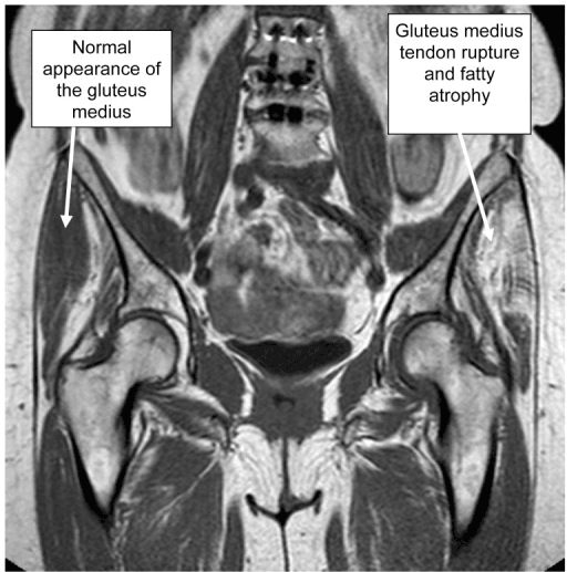 Coronal T1 MRI of the pelvis comparing a normal gluteus medius with a torn, fatty-atrophic gluteus medius