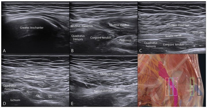 Six-panel ultrasound map obtained by translating the transducer medially from the greater trochanter, sequentially identifying gluteus medius, gluteus minimus, piriformis, obturator internus, gemelli, quadratus femoris and the sciatic nerve