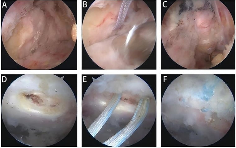 Six arthroscopic frames comparing full-thickness and partial gluteus medius tears, footprint preparation, anchor placement and completed repair