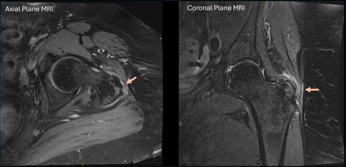 Axial and coronal fat-suppressed T2-weighted MRI showing gluteus medius and minimus tendon tears with severe background tendinopathy
