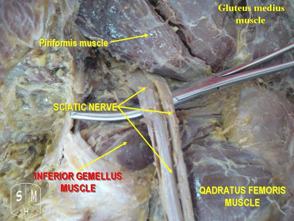 Cadaveric dissection of the deep gluteal region: the gluteus medius lies superolaterally (upper right), with the piriformis below it and, emerging beneath piriformis, the sciatic nerve, the inferior gemellus and the quadratus femoris.