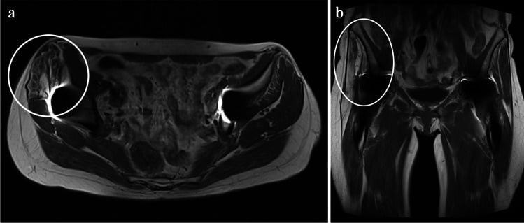 Axial and coronal T1-weighted MRI showing severe right gluteus medius volume loss and Goutallier grade 4 fatty replacement