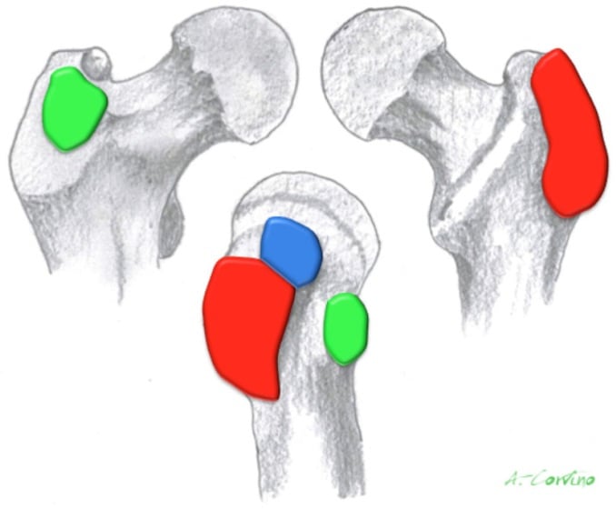 Three-dimensional anatomical illustration marking the trochanteric bursa, subgluteus medius bursa and subgluteus minimus bursa around the greater trochanter