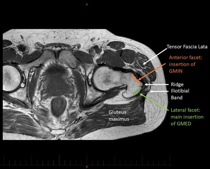 Axial T1-weighted MRI at the greater trochanter with the anterior and lateral facets, gluteus minimus and medius insertions, iliotibial band, tensor fasciae latae and gluteus maximus labelled