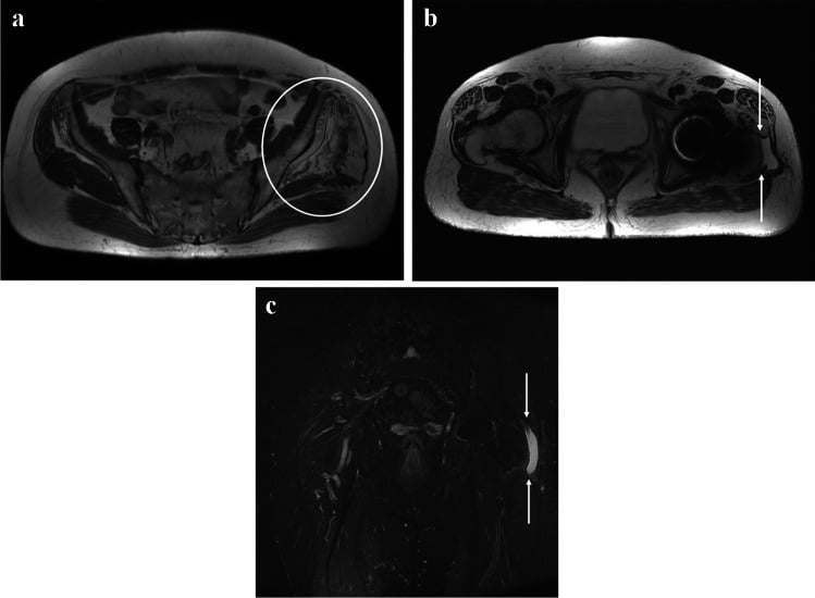 Axial T1, axial T2 and coronal STIR MRI of a left gluteus medius insertional tear with associated fatty atrophy
