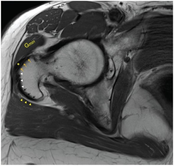 Axial T1-weighted MRI of intact hip abductors showing the anterior, lateral and posterior greater-trochanter facets, gluteus minimus tendon and trochanteric bursa