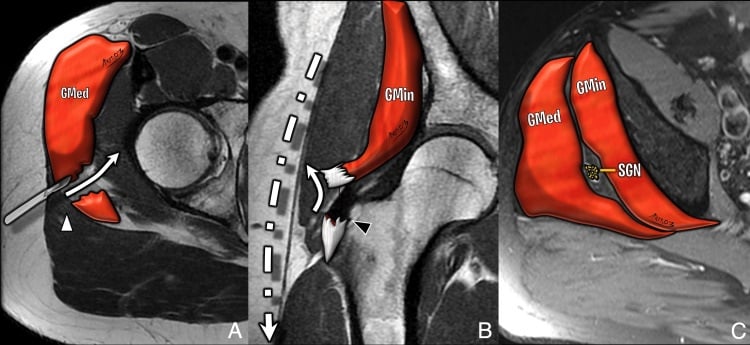Three-panel MRI-based illustration of the lateral hip approach showing the gluteus medius split, gluteus minimus tenotomy and superior gluteal nerve at risk proximally