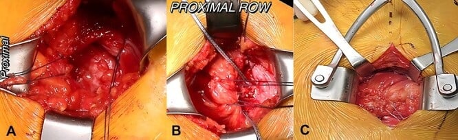 Three open operative photographs showing gluteus medius and minimus tear mobilisation, proximal-row anchor placement and completed four-anchor repair