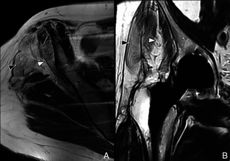 Axial and coronal postoperative MRI showing gluteus minimus and anterior gluteus medius atrophy after a lateral hip approach
