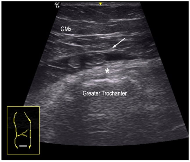 Short-axis ultrasound of the lateral hip showing hypoechoic distension of the trochanteric bursa superficial to the gluteus medius tendon and greater trochanter