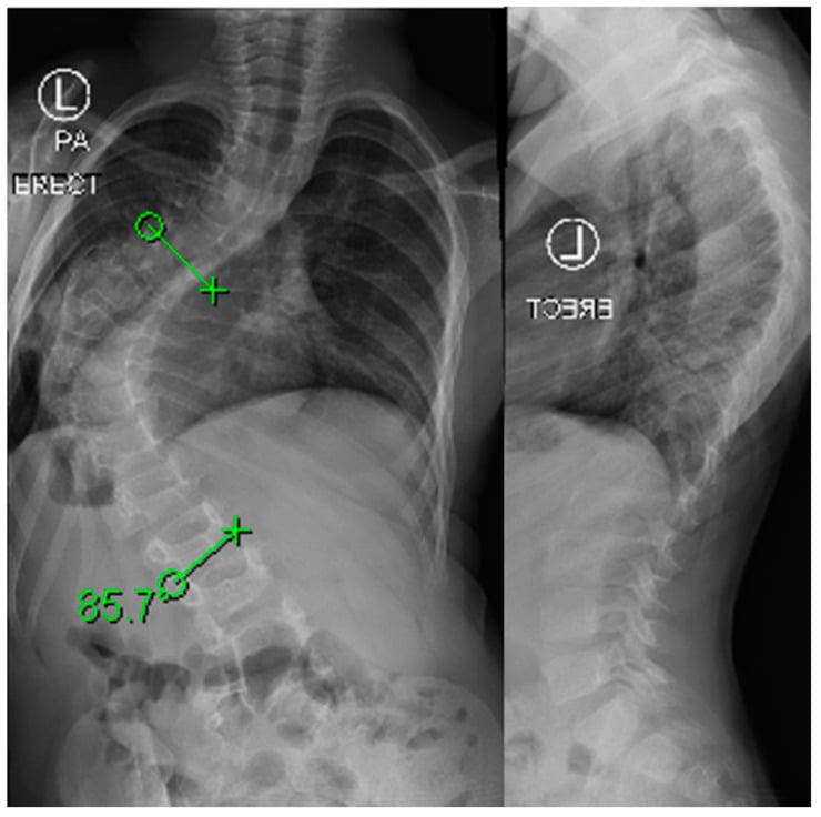 Preoperative radiographs showing early-onset scoliosis progression despite casting