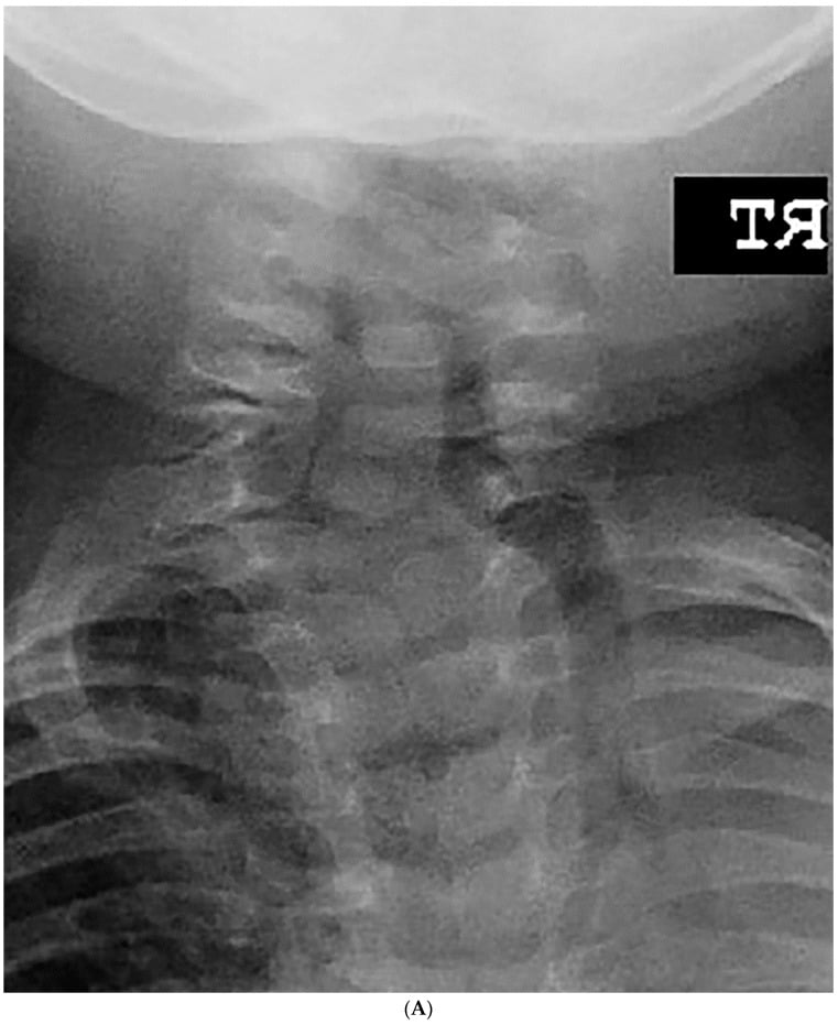 Serial radiographs showing C3 and C7 hemivertebrae with progressive cervical and compensatory curves