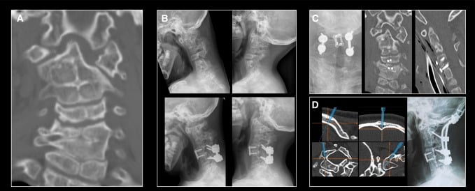 Cervical imaging showing C1 malformation, multilevel fusion and progressive instability