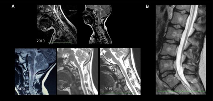 Serial cervical MRI showing multilevel instability in oculo-auriculo-vertebral dysplasia