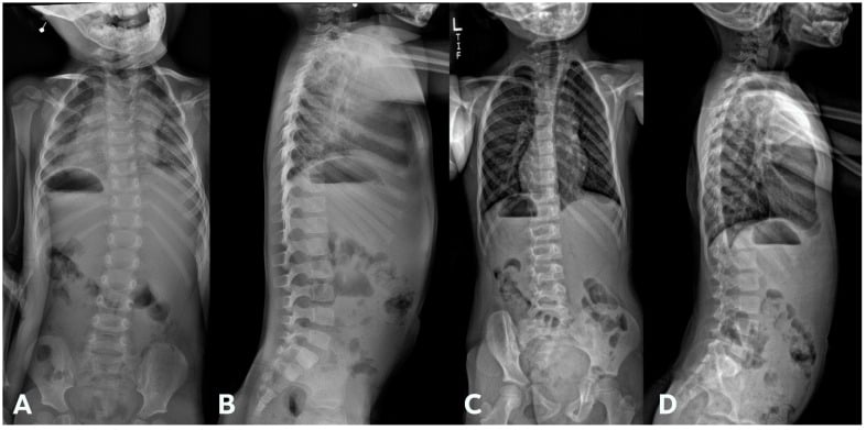 Serial standing radiographs showing progression of congenital cervicothoracic scoliosis