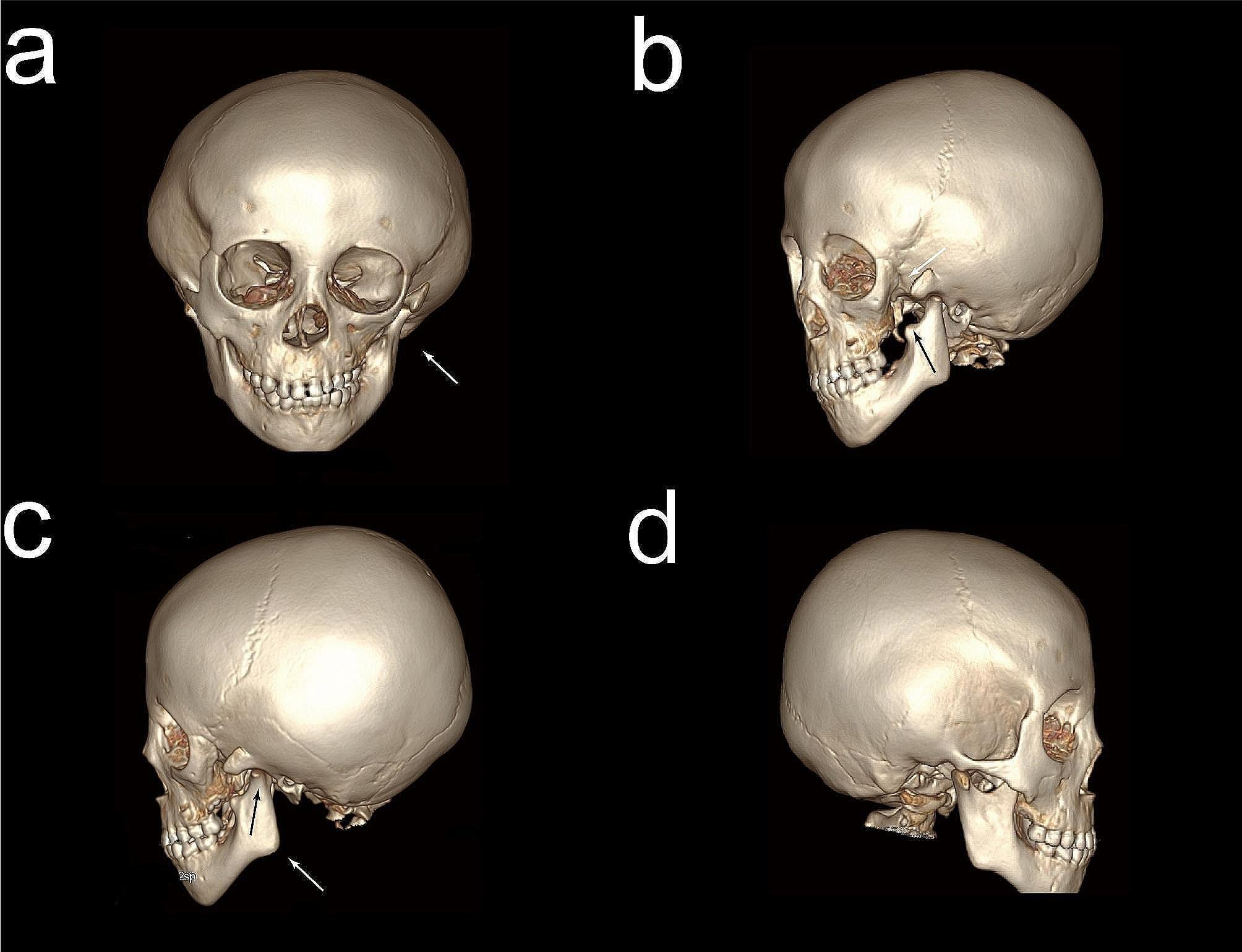 Multiplanar skull CT showing asymmetric mandibular and zygomatic development in Goldenhar syndrome
