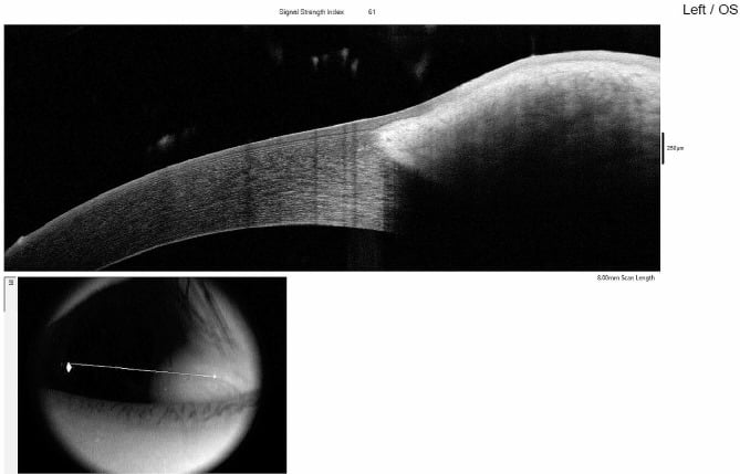 Anterior-segment OCT showing stromal infiltration by an epibulbar dermoid