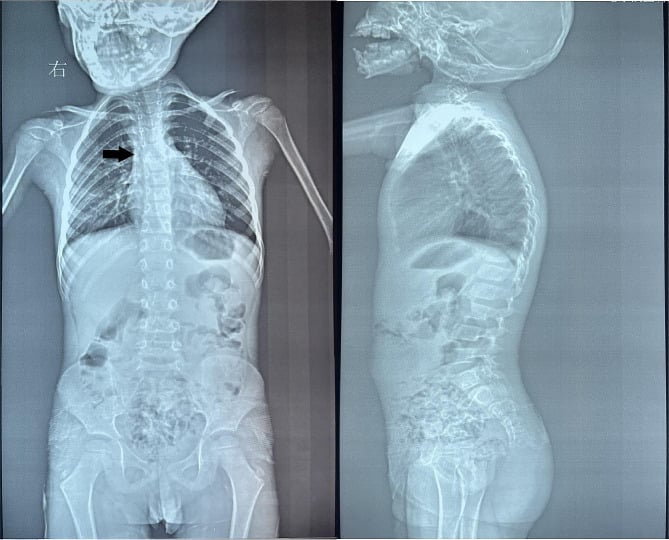 Spine radiograph showing scoliosis in Goldenhar syndrome